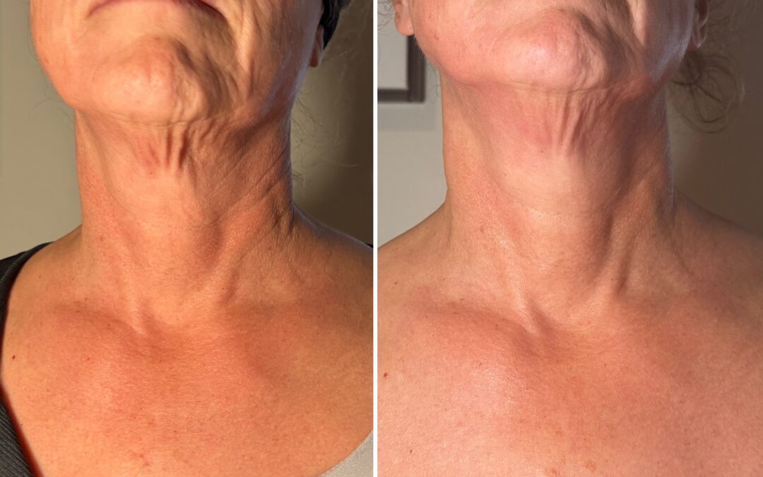 Snatched & Sculpted: The Best Treatments for Double Chin and Body Contouring in Santa Rosa